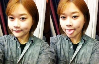 人造酒窩有后遺癥