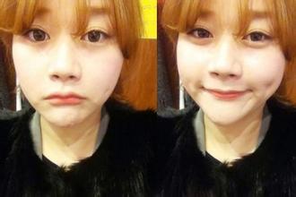 人造酒窩有后遺癥