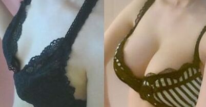 假體隆胸后能哺乳嗎,假體隆胸后多久可以哺乳
