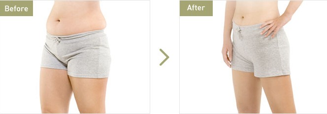 腰部,吸脂,副作用