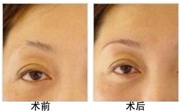 眉毛整形果圖