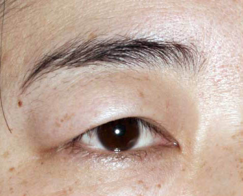 眉毛整形前后對(duì)比