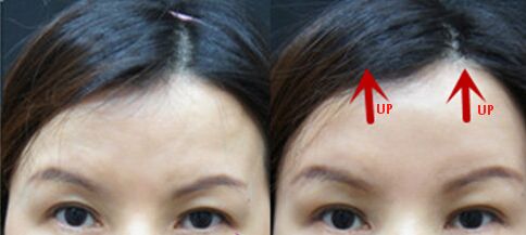 眉毛整形前后對(duì)比