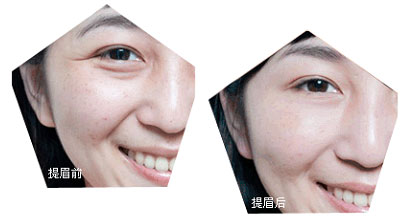 提眉切眉術前的注意事項