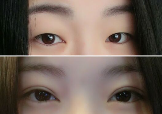 雙眼皮幾天能恢復(fù)
