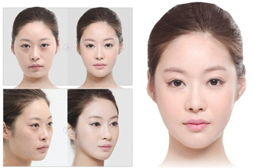 上海第九人民醫(yī)院,去眼袋,多少錢