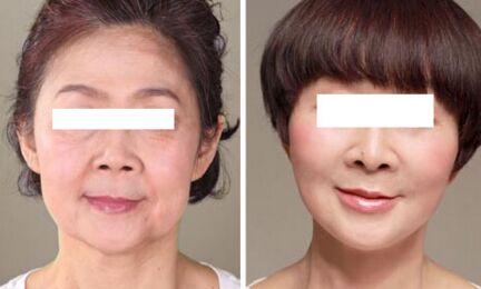 注射伊w蘭除皺紋成好嗎