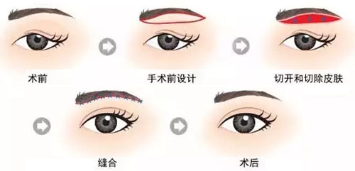 切眉術(shù)手術(shù)過(guò)程