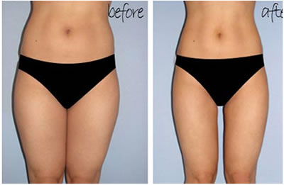 山東武警醫(yī)院吸脂整形前后對比圖