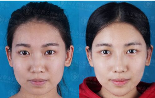 南京維多利亞整形醫(yī)院做自體脂肪隆鼻好不好