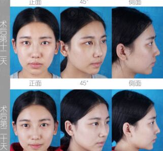 南京維多利亞整形醫(yī)院做自體脂肪隆鼻好不好