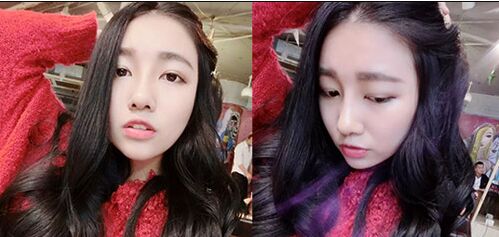 南京維多利亞整形醫(yī)院做自體脂肪隆鼻好不好