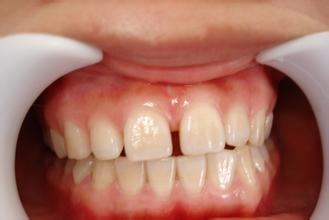 補牙縫,一般,需要,多少錢