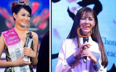 沈夢辰整容對比圖 下巴塞的假體被發(fā)現(xiàn)