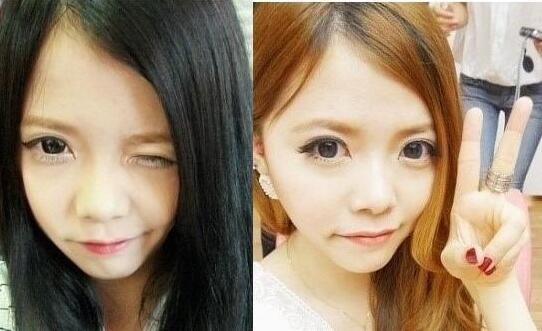 硅膠隆鼻手術(shù)圓了我高鼻梁的夢