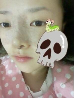 硅膠隆鼻手術(shù)圓了我高鼻梁的夢