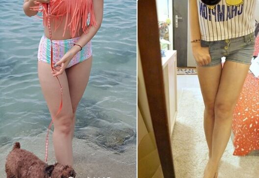 吸脂瘦大腿讓我變回纖纖細(xì)腿