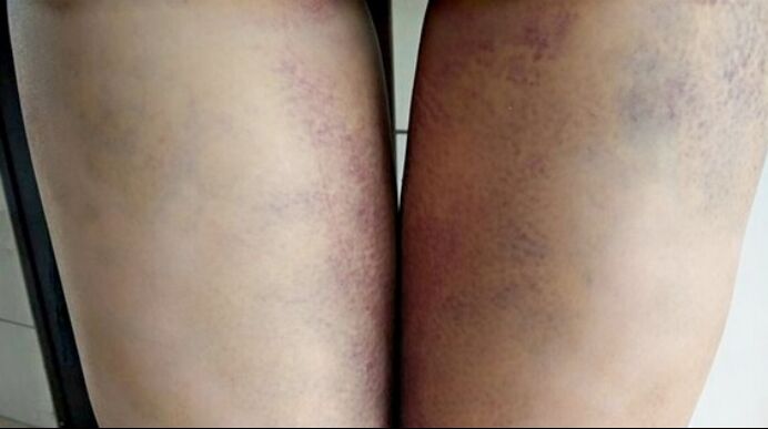 吸脂瘦大腿讓我變回纖纖細(xì)腿