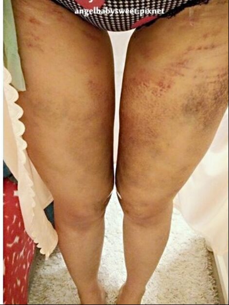 吸脂瘦大腿讓我變回纖纖細(xì)腿