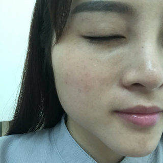 做了高強(qiáng)度聚焦超聲除皺小細(xì)紋都沒有啦 大家快來圍觀啊