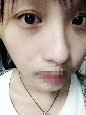 割雙眼皮恢復過程圖