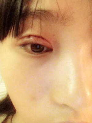 雙眼皮恢復過程經(jīng)歷