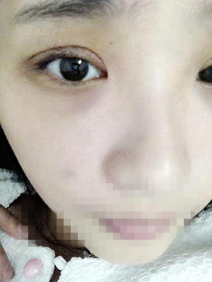 割雙眼皮恢復過程圖