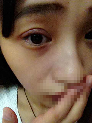 割雙眼皮恢復過程圖