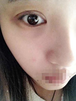 割雙眼皮恢復過程圖