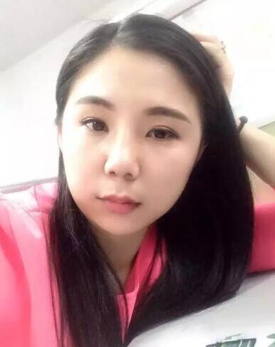 項(xiàng)昌峰醫(yī)生做的隆鼻整形速來看看果怎么樣