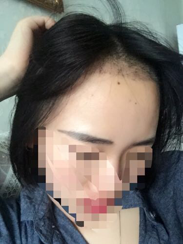 成都玉之光頭發(fā)移植 果杠杠的~