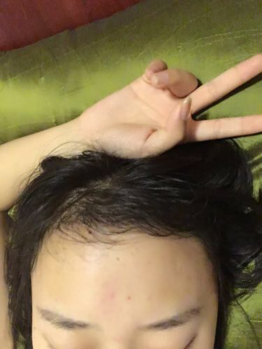 成都玉之光頭發(fā)移植 果杠杠的~