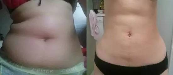 北京炫美腹部吸脂術后 穿衣服更有型了！