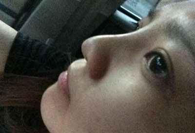 假體隆鼻15天后恢復(fù)果 杭州時(shí)光做的~