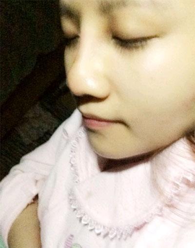 假體隆鼻15天后恢復(fù)果 杭州時(shí)光做的~