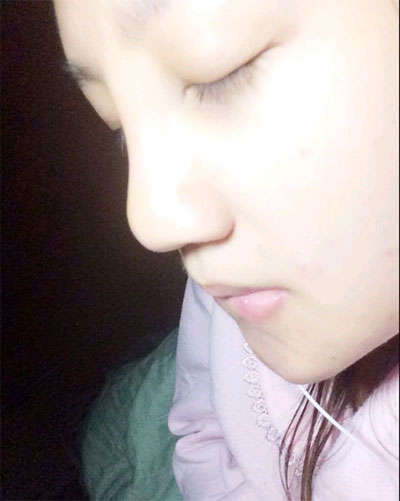 假體隆鼻15天后恢復(fù)果 杭州時(shí)光做的~