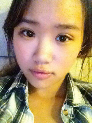 納米x雕雙眼皮15天了~ 我恢復(fù)的算快嗎