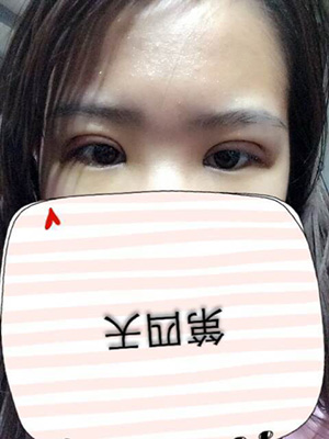 納米x雕雙眼皮15天了~ 我恢復(fù)的算快嗎