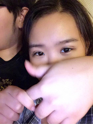 納米x雕雙眼皮15天了~ 我恢復(fù)的算快嗎