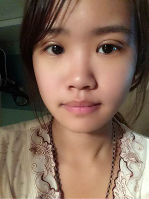 納米x雕雙眼皮15天了~ 我恢復(fù)的算快嗎