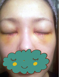 杭州時光激光去眼袋1個月了