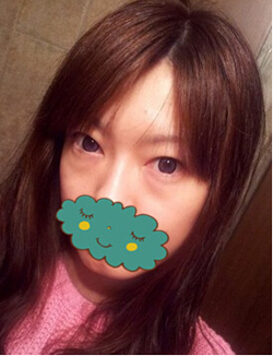 杭州時光激光去眼袋1個月了