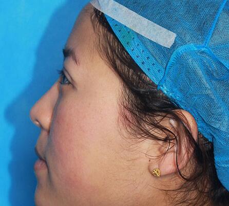 雙眼皮手術(shù)讓我單眼皮變雙眼皮就是這么簡(jiǎn)單