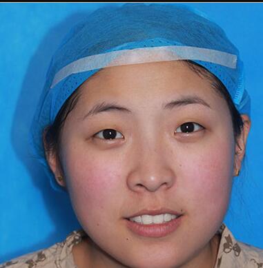 雙眼皮手術(shù)讓我單眼皮變雙眼皮就是這么簡(jiǎn)單