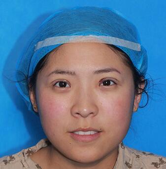 雙眼皮手術(shù)讓我單眼皮變雙眼皮就是這么簡(jiǎn)單