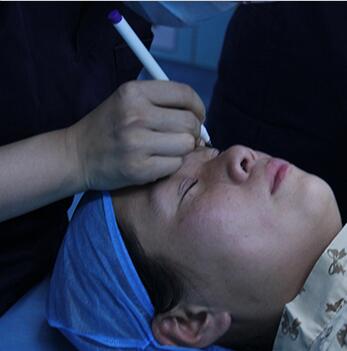 雙眼皮手術(shù)讓我單眼皮變雙眼皮就是這么簡(jiǎn)單