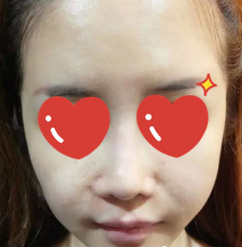 做了拉皮除皺 我的皮膚越來越緊致光滑了