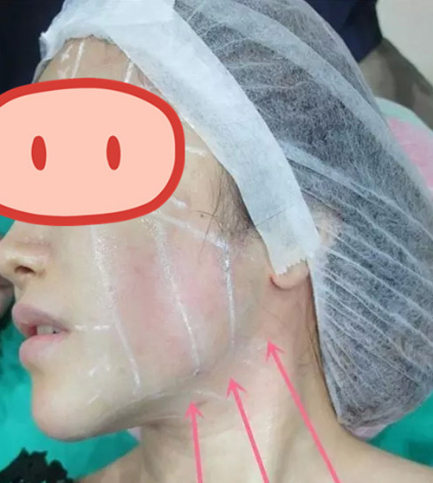 做了拉皮除皺 我的皮膚越來越緊致光滑了