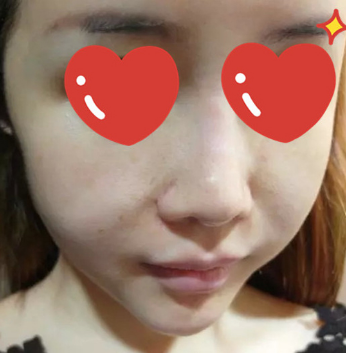 做了拉皮除皺 我的皮膚越來越緊致光滑了