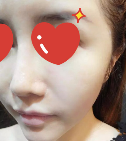 做了拉皮除皺 我的皮膚越來越緊致光滑了